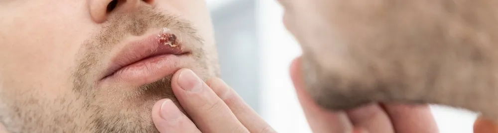 como saber se é herpes labial_1.webp