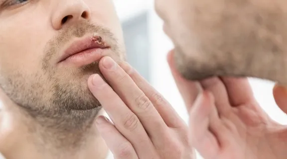 Como saber se é herpes labial? Veja com identificar as lesões