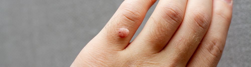 como são as verrugas do hpv1.jpg