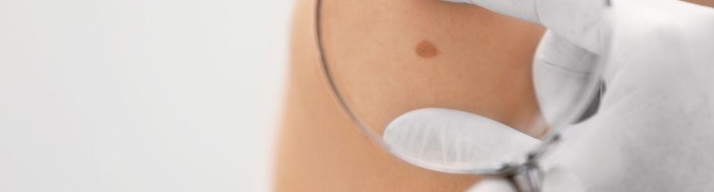 como se inicia o câncer de pele1.jpg