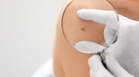 Como se inicia o câncer de pele: veja quando buscar ajuda médica
