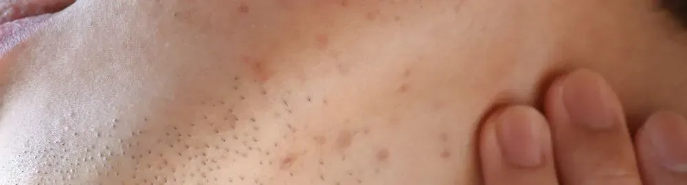 como tirar manchas de espinha do rosto_1.webp