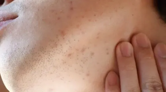 Como tirar manchas de espinha do rosto: o que funciona para tratar?