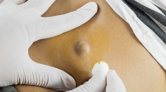 Como tratar cisto sebáceo na virilha: tratamentos e quando ir ao médico