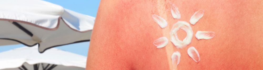 como tratar queimadura de sol_1.jpg