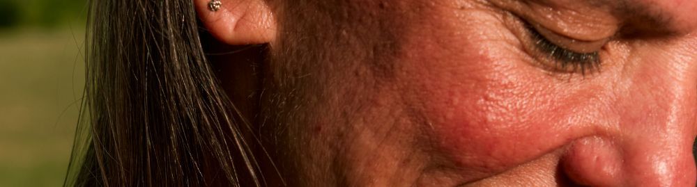 como tratar queimadura de sol no rosto_1.jpg