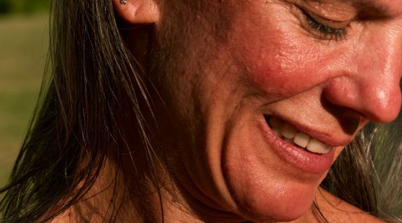 Como tratar queimadura de sol no rosto e quando procurar um dermatologista