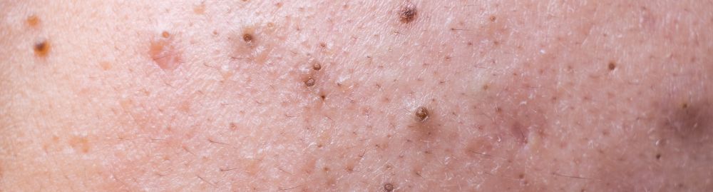 cravo nos seios1.jpg