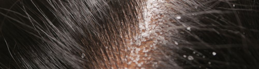 dermatite atópica no couro cabeludo_1.jpg