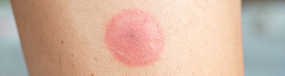 doença de lyme sintomas​1.jpg