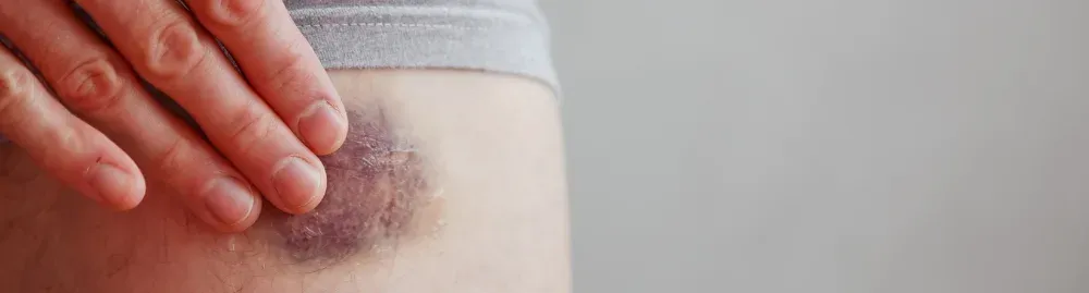 doenças que baixam as plaquetas1.webp