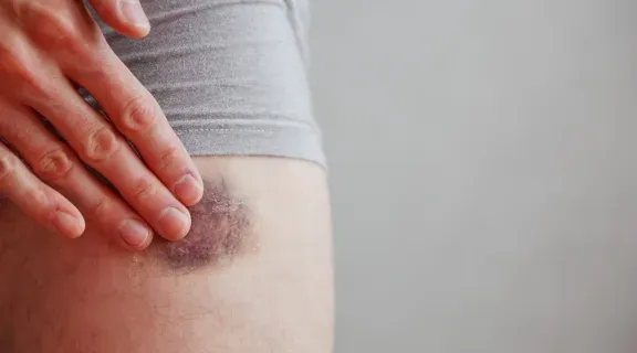 Doenças que baixam as plaquetas: entenda quais as causas