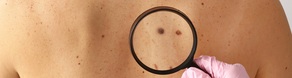 em quanto tempo o melanoma se espalha1.jpg