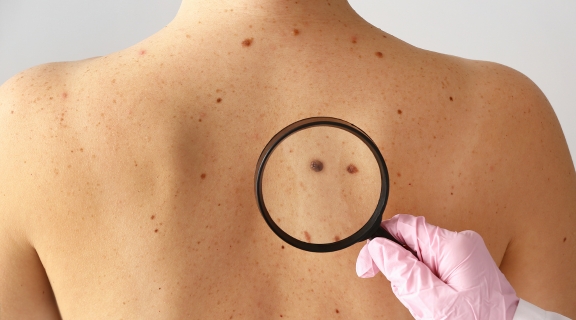 Em quanto tempo o melanoma se espalha? Veja como tratar o câncer de pele