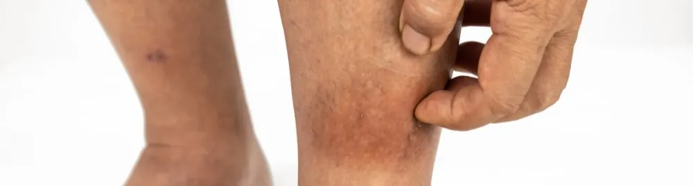erisipela é contagiosa1.webp