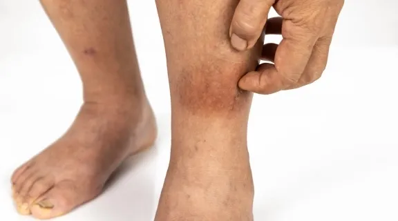 Erisipela é contagiosa? Veja como a infecção acontece e formas de prevenir