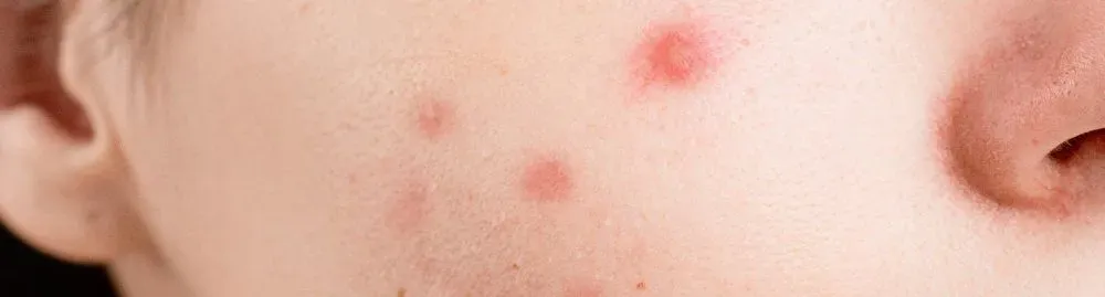 espinha inflamada com pus_1.webp