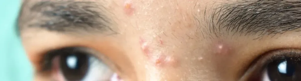 fase lútea sintomas1.webp