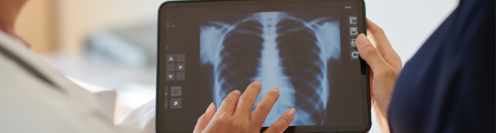 fibrose pulmonar1.jpg