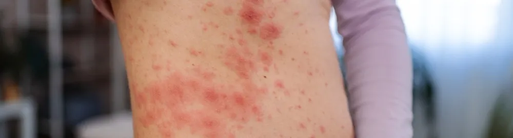 hanseníase é contagiosa1.webp