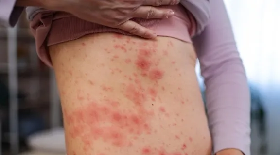 Hanseníase é contagiosa? Saiba as formas de transmissão e como tratar
