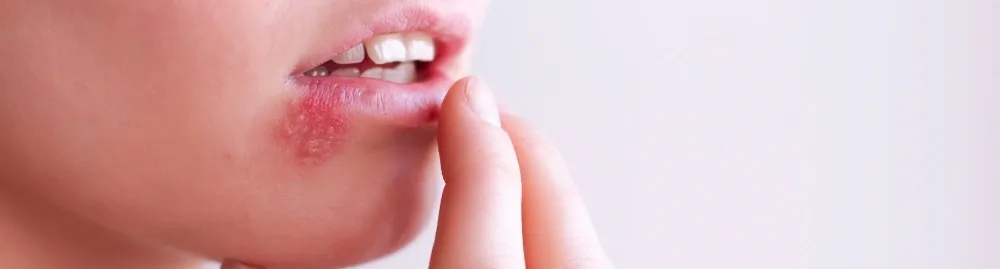herpes labial sintomas1.webp