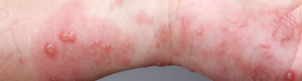 herpes zoster é contagioso1.jpg