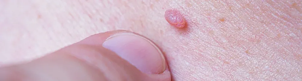 hpv em meninos​1.webp