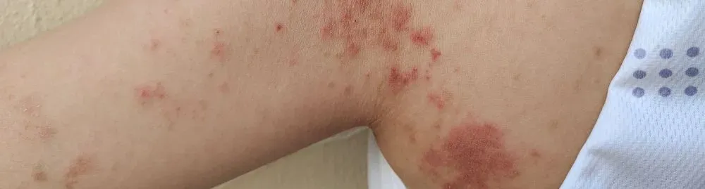 impetigo bolhoso tratamento1.webp