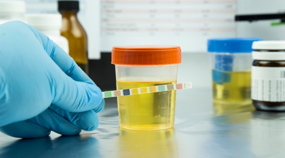Infecção nos rins aparece no exame de urina? Veja como identificar