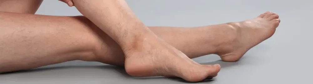 insuficiência venosa pode matar_1.webp