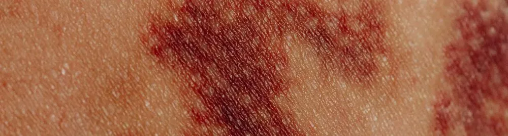 lúpus eritematoso​1.webp