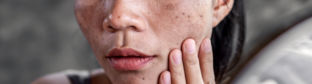 melasma na gravidez sai depois​1.jpg