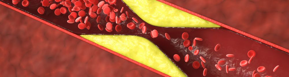 o que aterosclerose1.jpg