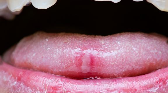 O que causa aftas na língua: entenda os principais fatores e como prevenir
