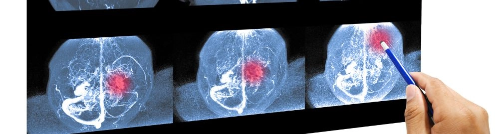 o que causa aneurisma cerebral1.webp