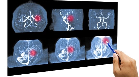 O que causa o aneurisma cerebral e como é possível preveni-lo?