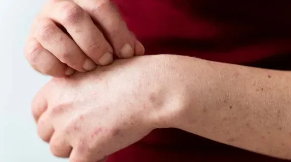 O que causa o pano branco​: fatores genéticos, clima, suor e outros