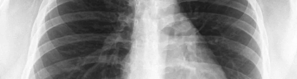 o que é água no pulmão_1.webp