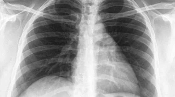 Água no pulmão: o que é, quais são os sintomas e como é feito o tratamento