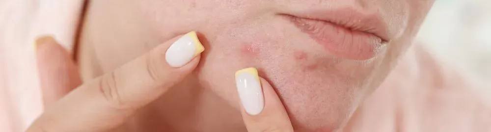 o que é bom para espinha inflamada_1.webp