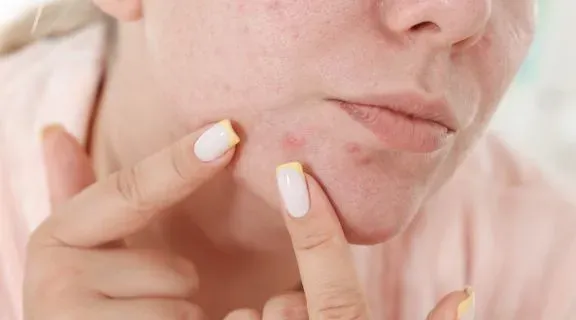 O que é bom para espinha inflamada? Como aliviar a dor e evitar manchas