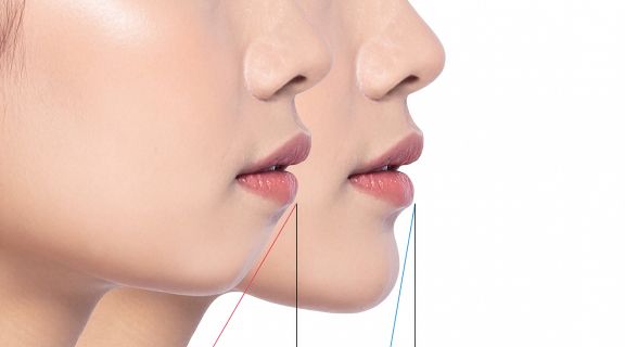 O que é cirurgia ortognática e quando o procedimento corretivo é indicado?