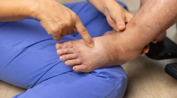 O que é edema nas pernas e quando se preocupar e buscar ajuda médica?
