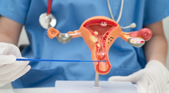 O que é neoplasia intraepitelial cervical grau 2, sintomas e como tratar