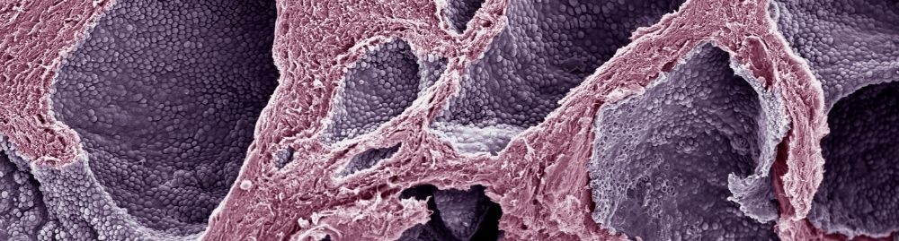 o que é neoplasia maligna da próstata1.jpg