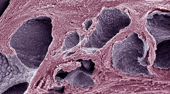 O que é neoplasia maligna da próstata: sintomas e como é o diagnóstico