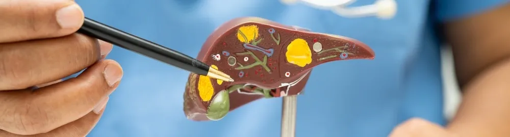 o que é pedra na vesícula1.webp