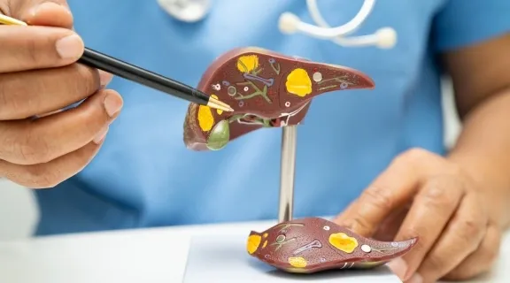 Pedra na vesícula: o que é, quais são os sintomas e por que tratar?