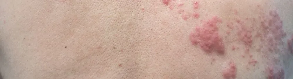 o que pode piorar a herpes zoster1.webp